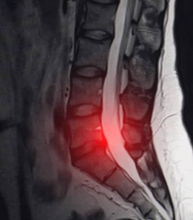 detectar a tiempo una hernia lumbar