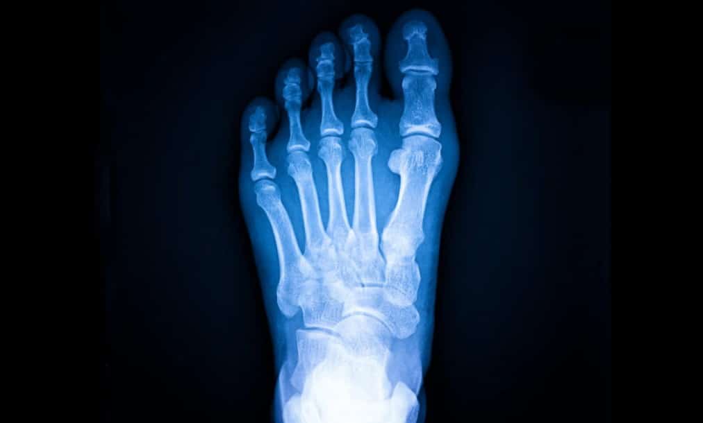 Qué son las fracturas por estrés