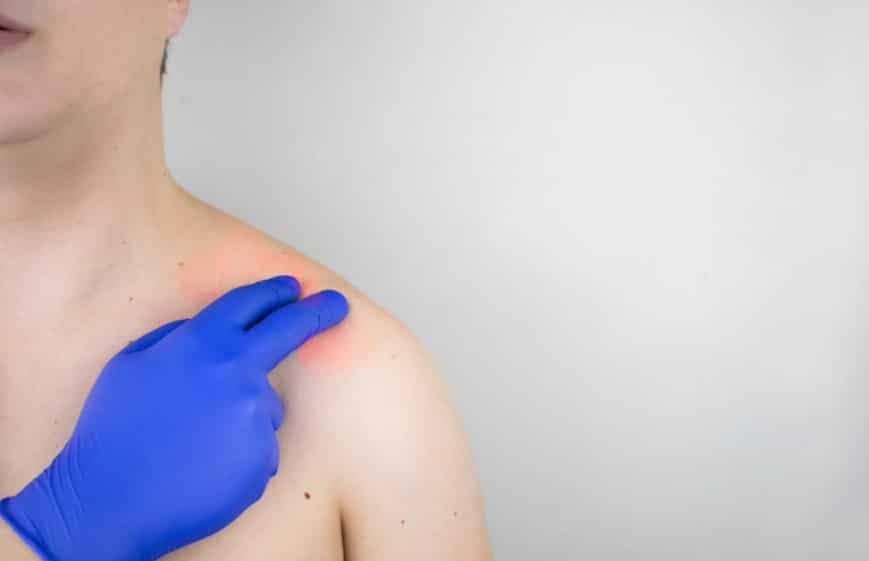 Tendinitis en el hombro